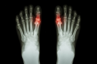 Gender and Gout