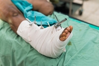 Benefits of External Fixators for Ankle and Foot Injuries