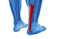 Achilles Tendon Injuries and the Impact on Athletes