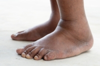 Swollen Feet and Ankles and When to Seek Podiatric Care